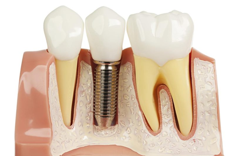 trồng răng implant có đau không