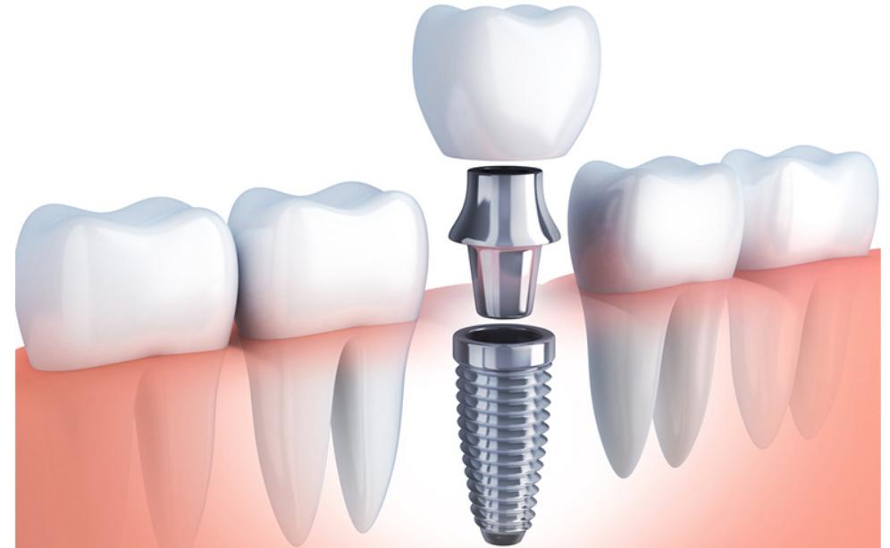 Các sĩ cấy implant giỏi
