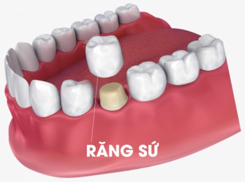 Bọc răng sứ là phương pháp giúp cải thiện thẩm mỹ và chức năng nhai
