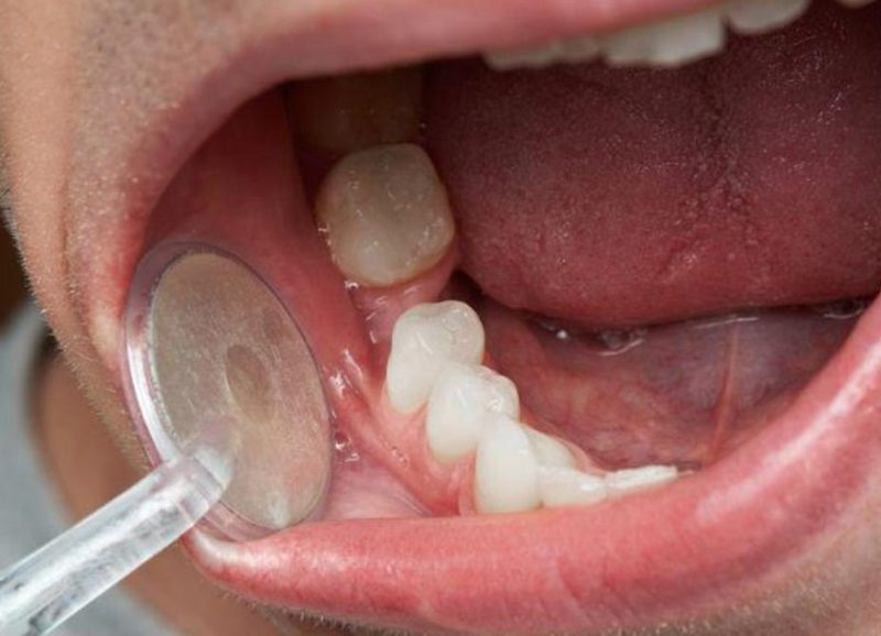 Lưu ý tình trạng răng miệng trước khi lựa chọn giữa làm cầu răng sứ và cấy ghép răng Implant