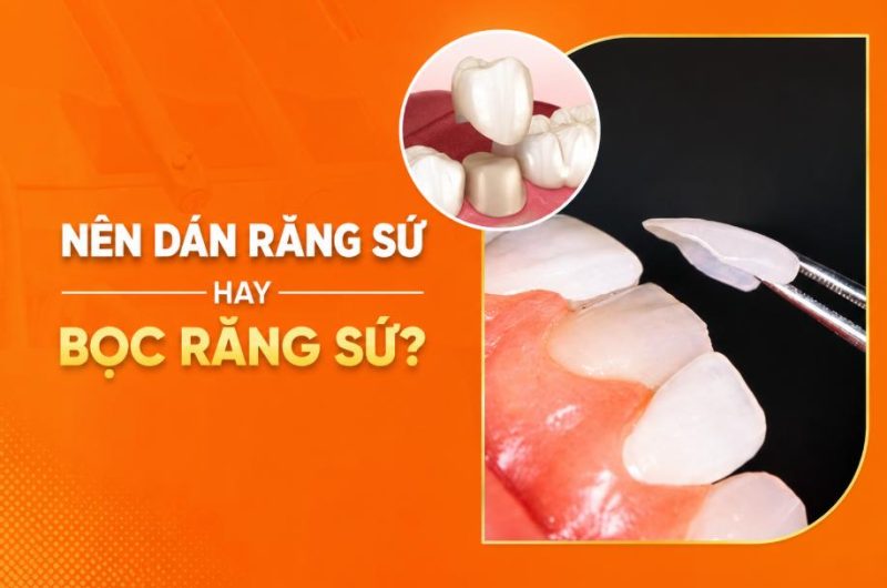 Việc chọn dán sứ hay bọc răng sứ phụ thuộc vào tình trạng răng thật của bạn