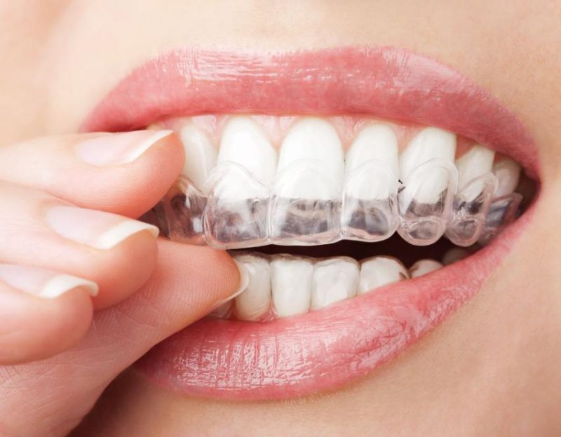 Niềng răng trong suốt là phương pháp chỉnh nha hiện đại sử dụng chuỗi khay nhựa trong suốt có thể tháo lắp