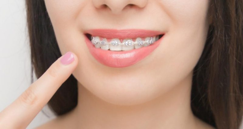 Niềng răng mắc cài sử dụng mắc cài và dây cung để dịch chuyển răng về đúng vị trí