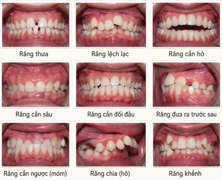 Niềng mắc cài phù hợp với những người bị răng hô, móm, mọc lệch lạc hoặc sai khớp cắn