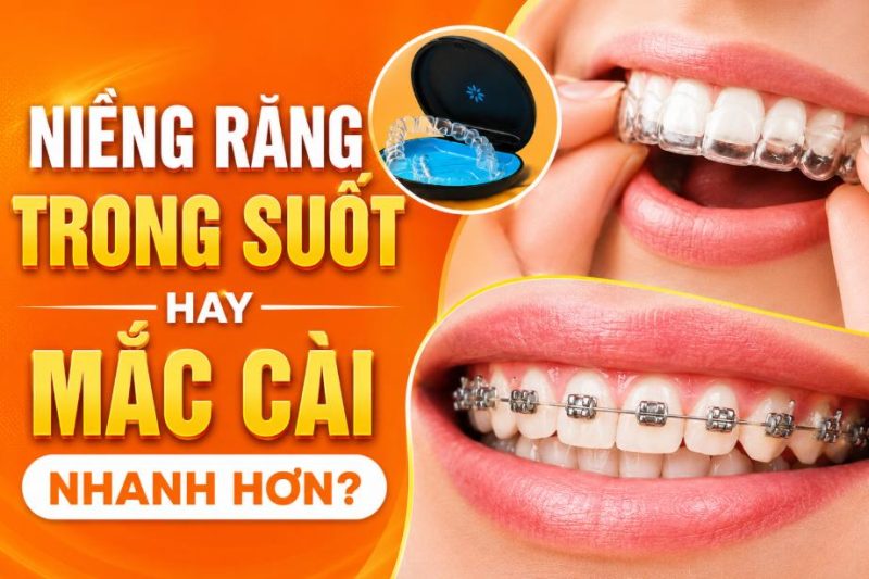 Niềng trong suốt hay mắc cài nhanh hơn