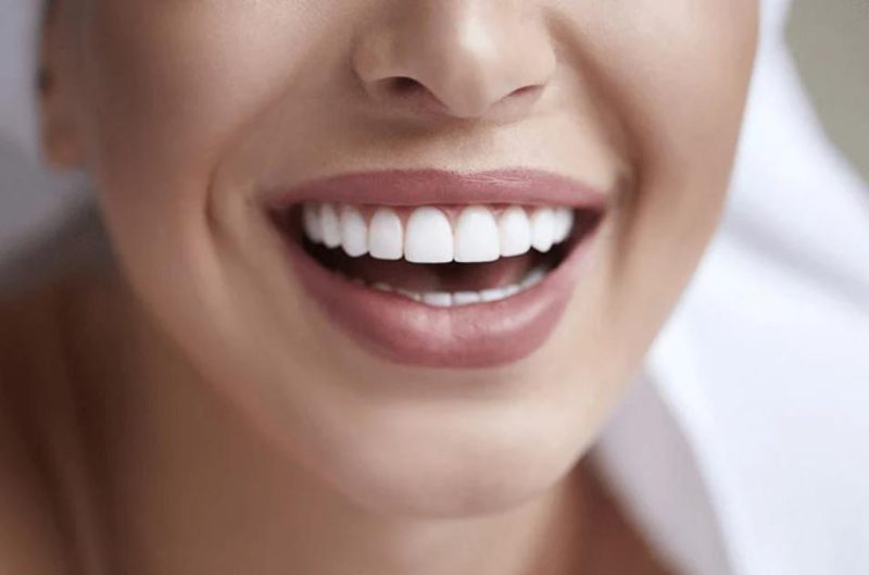 Răng toàn sứ có tính thẩm mỹ cao hơn