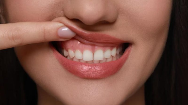 Răng sứ kim loại có thể làm đen viền nướu