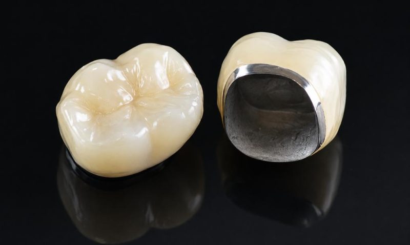 Răng sứ kim loại và răng sứ toàn sứ
