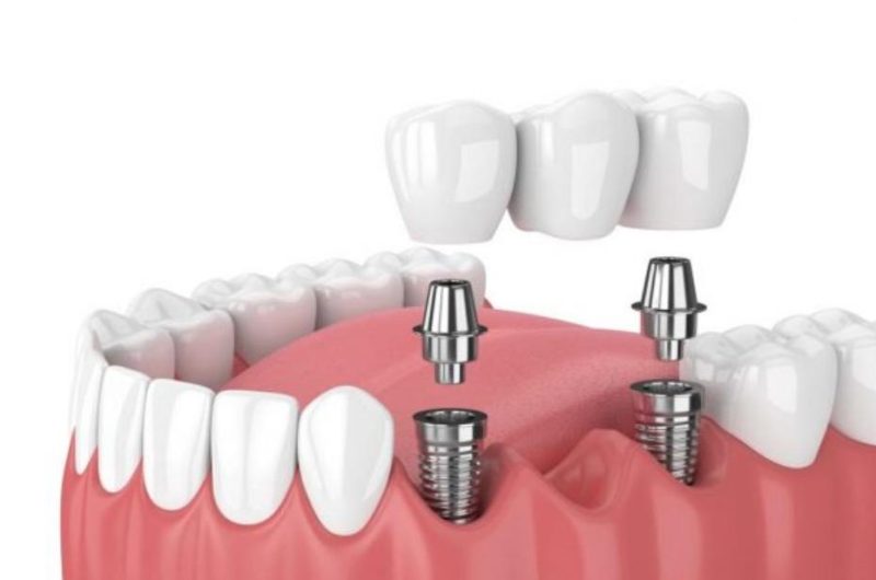 Trồng răng implant là phương pháp phục hình răng mất tối ưu nhất